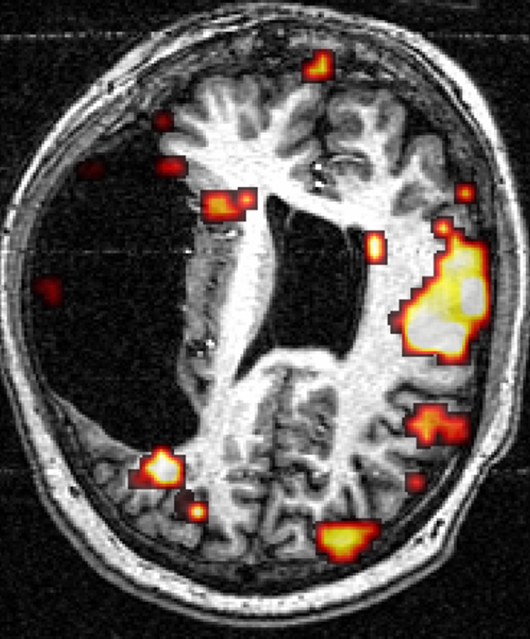 Functional brain-activation map from Daniel Branco's brain-mapping research